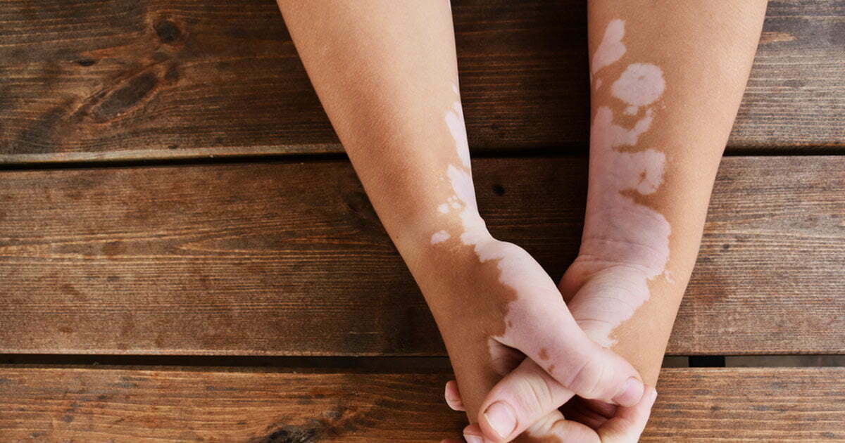 Rüyada Alaca Hastalığı Görmek Ve Yakalanmak Ne Anlama Gelir